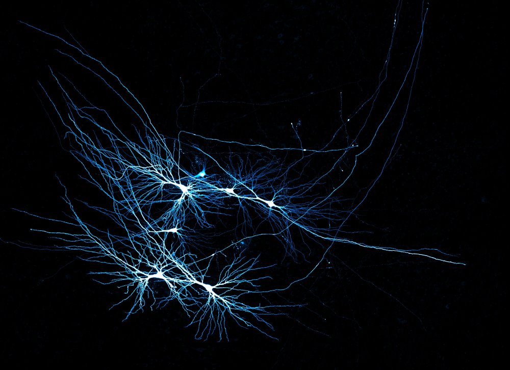 Human CA3 pyramidal neurons recorded in a patient tissue sample.