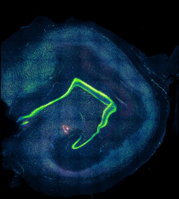 Multicellular recorded CA3 neurons, in human hippocampal tissue slice.